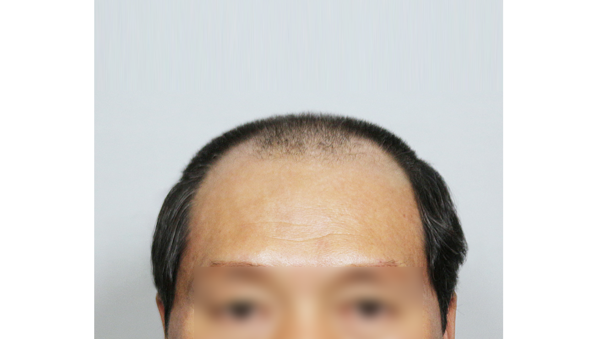 시술 전